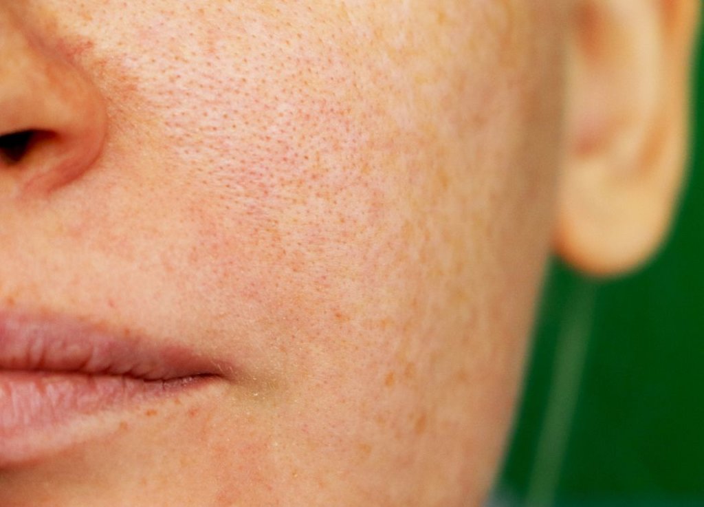 Causes of large pores