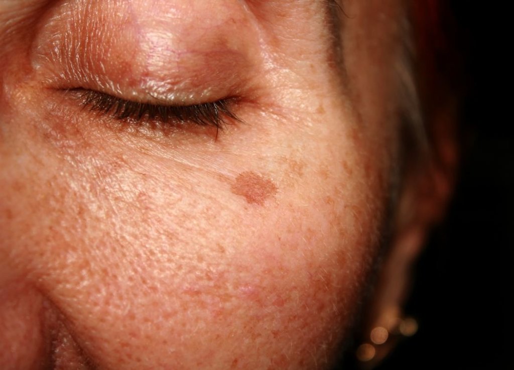 What Causes Brown Spots 